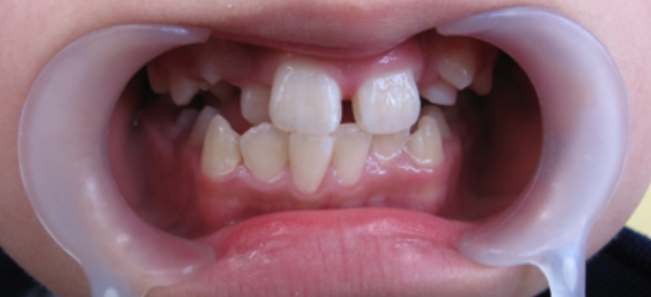 石巻　西村歯科医院のワイヤー矯正