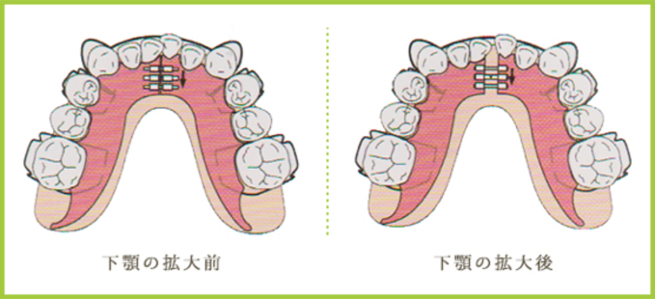 石巻　西村歯科医院の床矯正のメリットとデメリット
