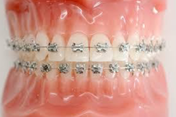 石巻　西村歯科医院のワイヤー矯正
