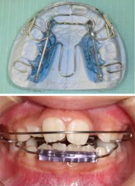 石巻　西村歯科医院のビムラー矯正