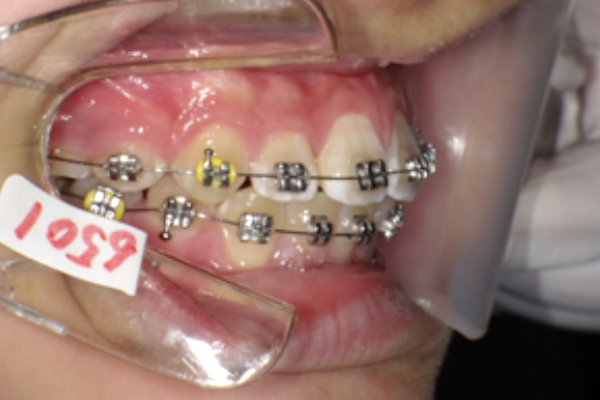 石巻　西村歯科医院のワイヤー矯正のメリットとデメリット