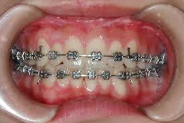 石巻　西村歯科医院のワイヤー矯正のメリットとデメリット